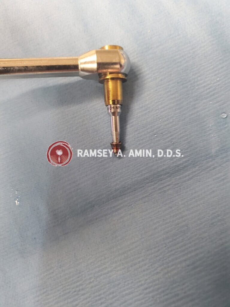 close up of dental implant components by Dr. Ramsey Amin of Burbank Dental Implants