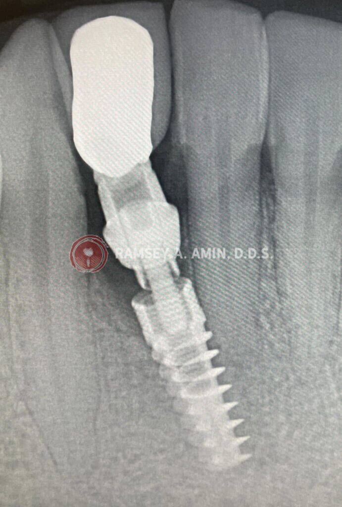 dental implant problems xray by Dr. Ramsey Amin of Burbank Dental Implants