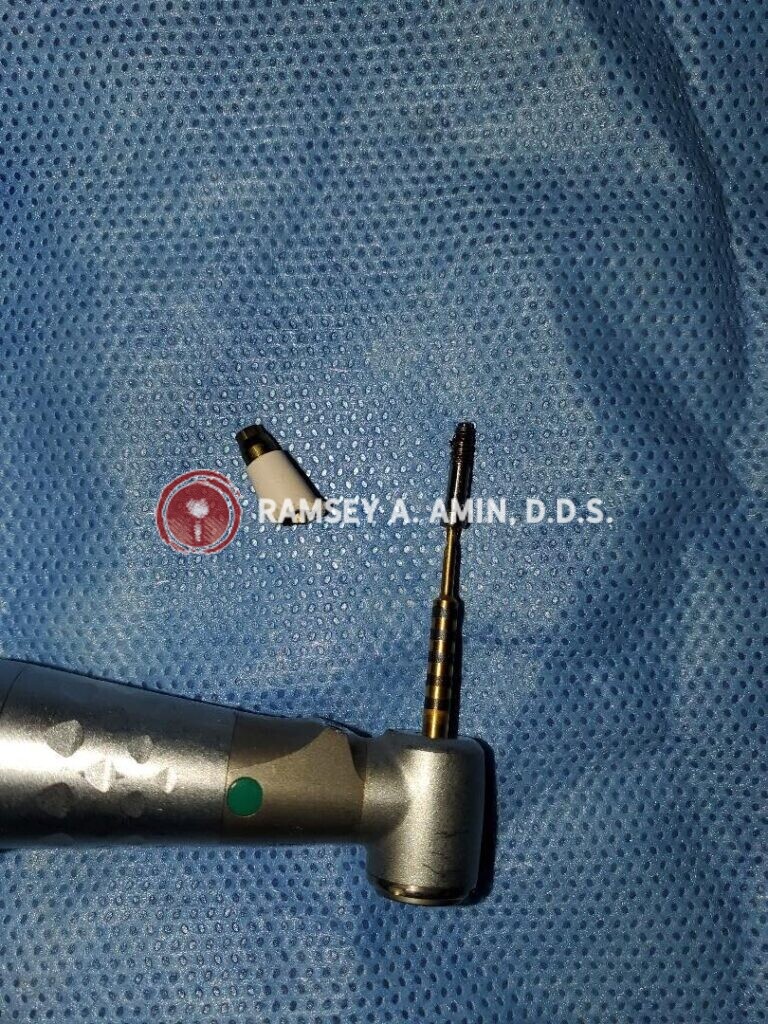 implant components by Dr. Ramsey Amin of Burbank Dental Implants