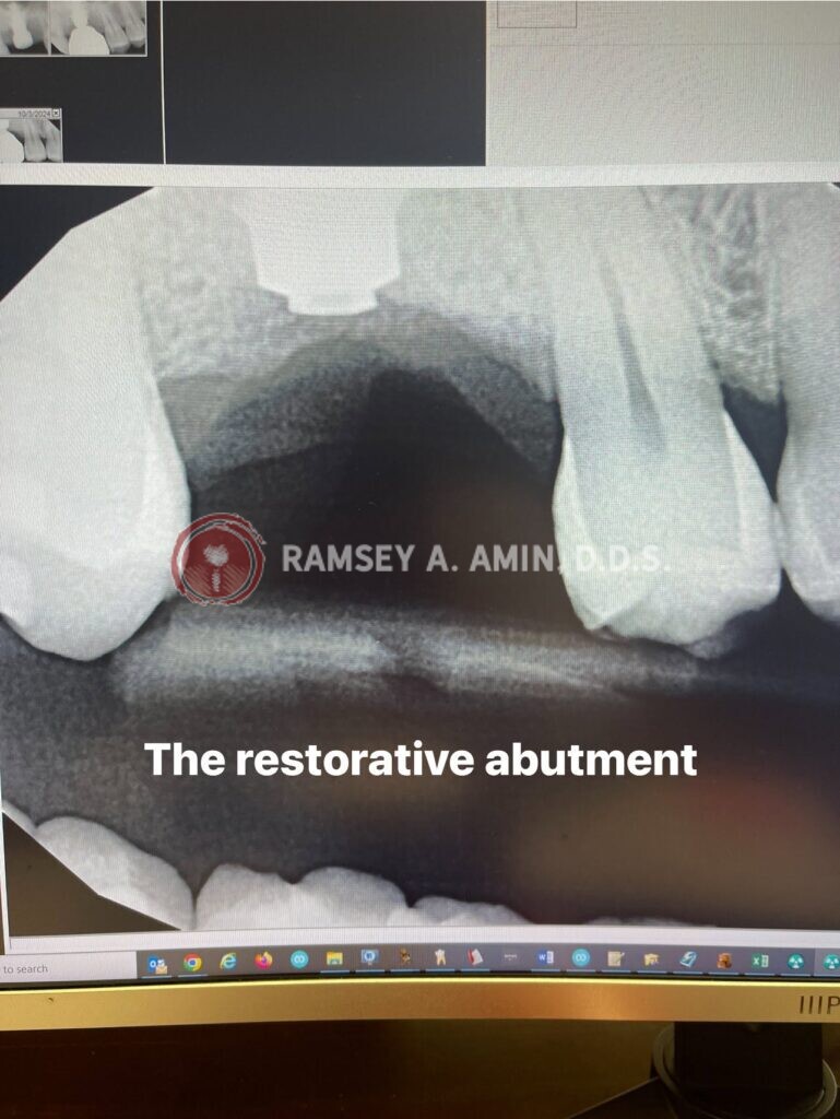 xray showing the restorative abutment by Dr. Ramsey Amin of Burbank Dental Implants
