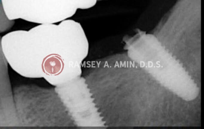 xray by Dr. Ramsey Amin of Burbank Dental Implants showing implant issues