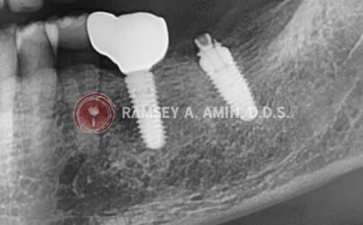 xray showing xray problems by Dr. Ramsey Amin of Burbank Dental Implants