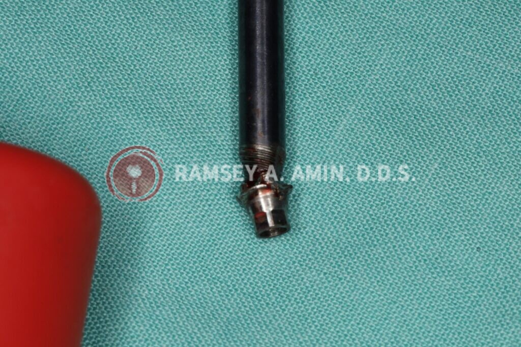 common dental implant issue by Ramsey Amin DDS of Burbank Dental Implants