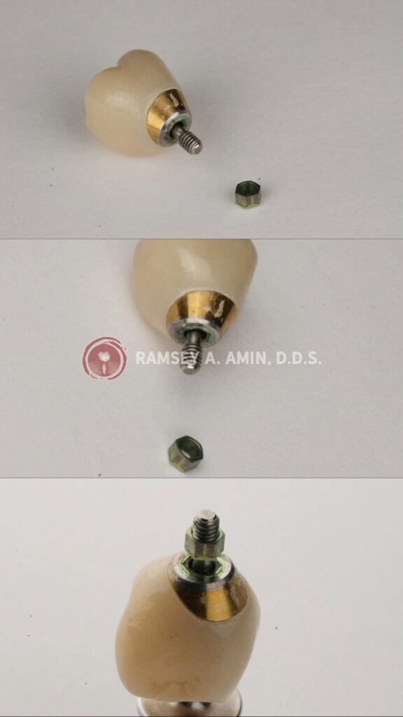 broken, loose or stripped dental implants by Ramsey Amin DDS of Burbank Dental Implants