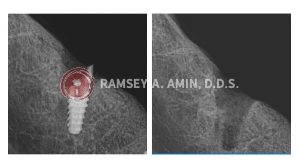 xray of dental implant problems by Dr. Ramsey Amin of Burbank Dental Implants