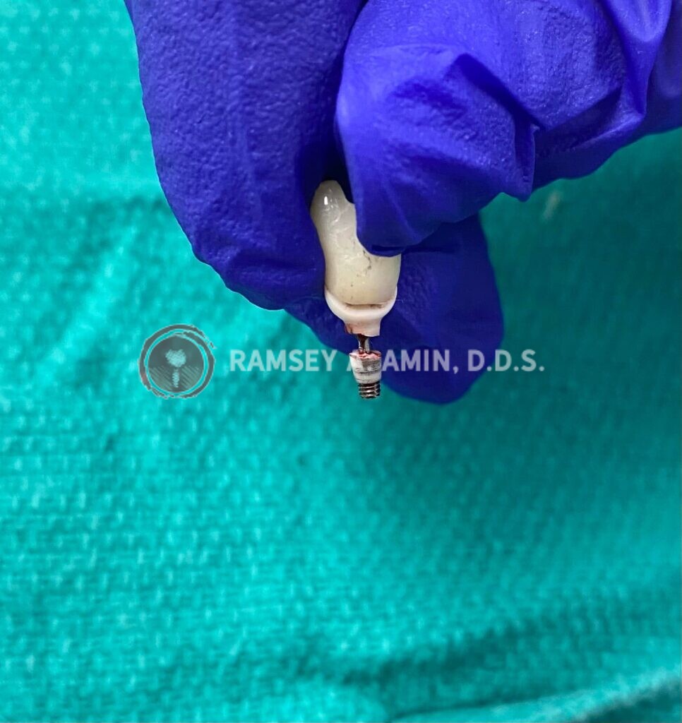 picture of broken dental implant abutment and screw by Dr. Amin