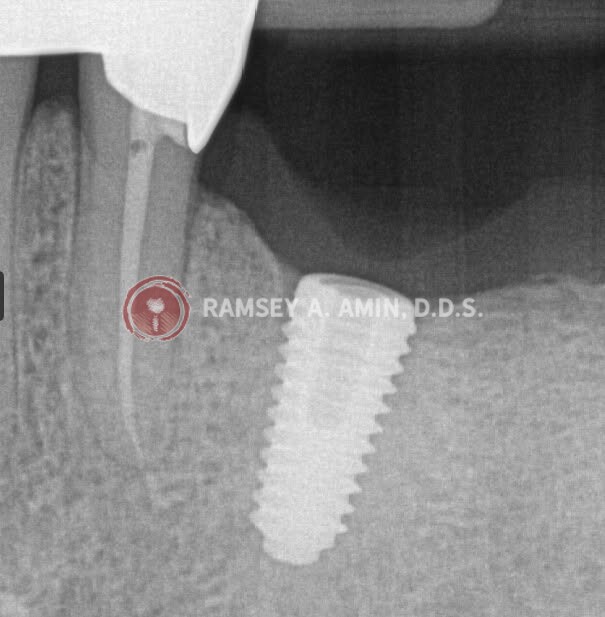 xray showing implant problems by Dr. Ramsey Amin of Burbank Dental Implants