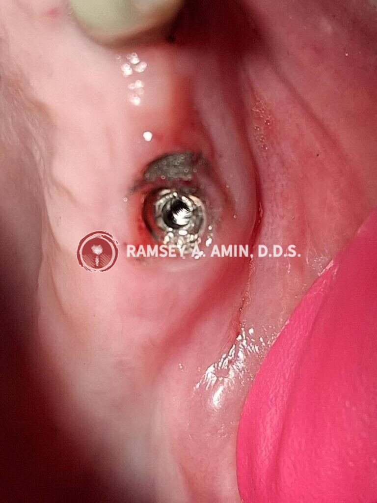 stripped dental implant abutment photo by Ramsey Amin DDS