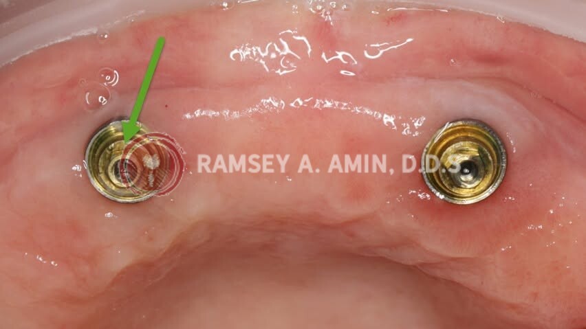 dental implant problem example by Dr. Amin