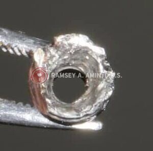 broken dental implant abutment photo by Ramsey Amin DDS