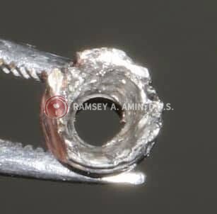 broken dental implant abutment photo by Ramsey Amin DDS