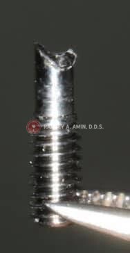 stripped dental implant screw photo by Ramsey Amin DDS