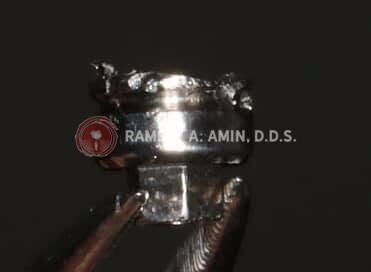 broken dental implant screw photo by Ramsey Amin DDS