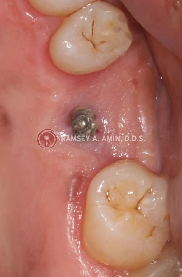 stripped dental implant screw by Dr. Amin