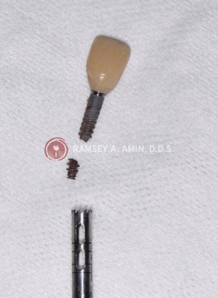 broken dental implant screw photo by Dr. Amin