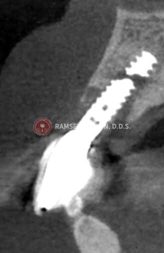xray by Dr. Amin showing dental implant problems