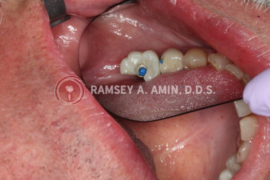 broken implant crown photo by Dr. Amin of Burbank Dental Implants