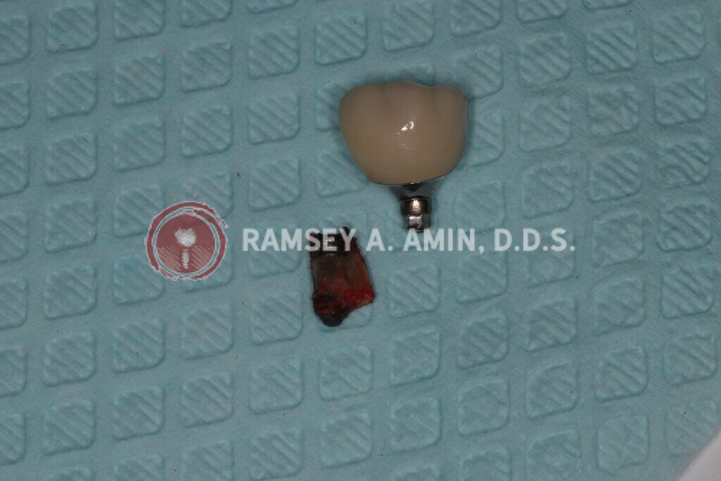 bad dental implant parts photo by Dr. Ramsey Amin