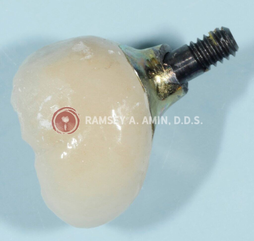damaged dental implant photo by Dr. Amin