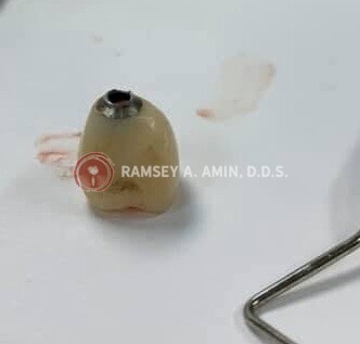 broken dental implant photo by Ramsey Amin DDS
