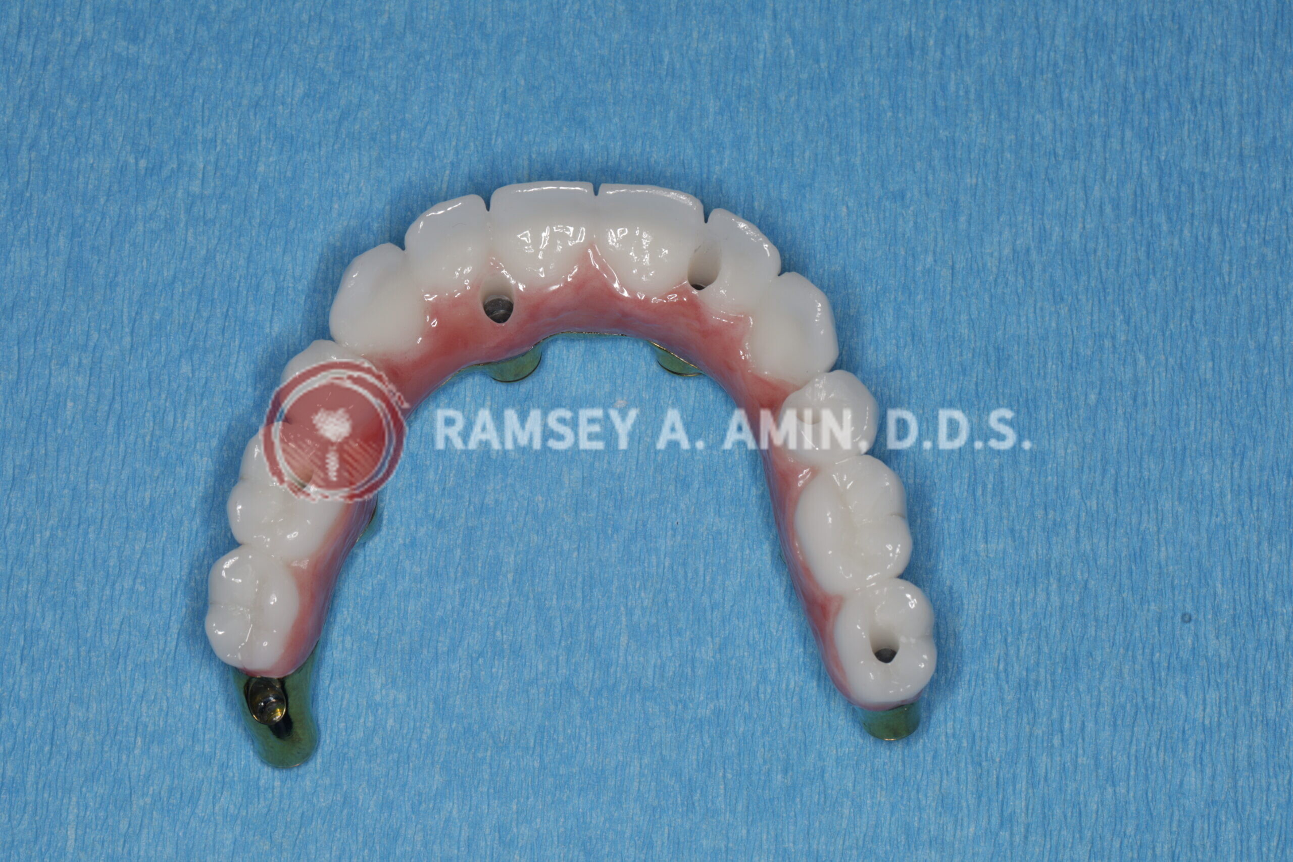 milled titanium bar design for Fp3 all on 4 bridge --pterygoids