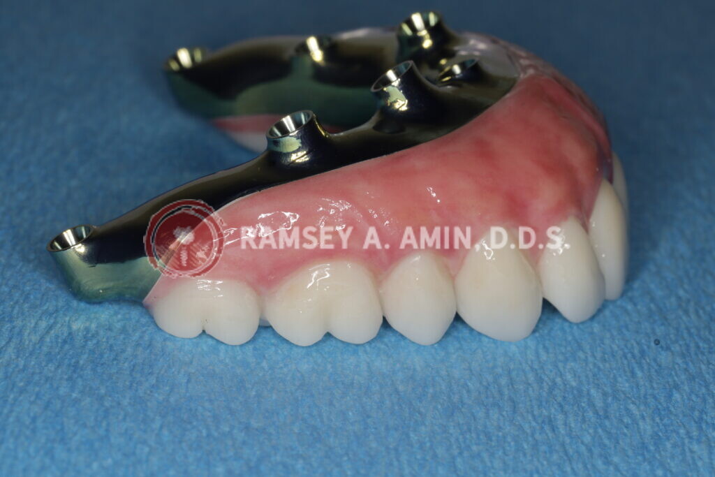 Milled titanium bar design for Fp3 all on 4 bridge = Lip Support - pterygoids - by Dr. Ramsey Amin of Burbank Dental Implants