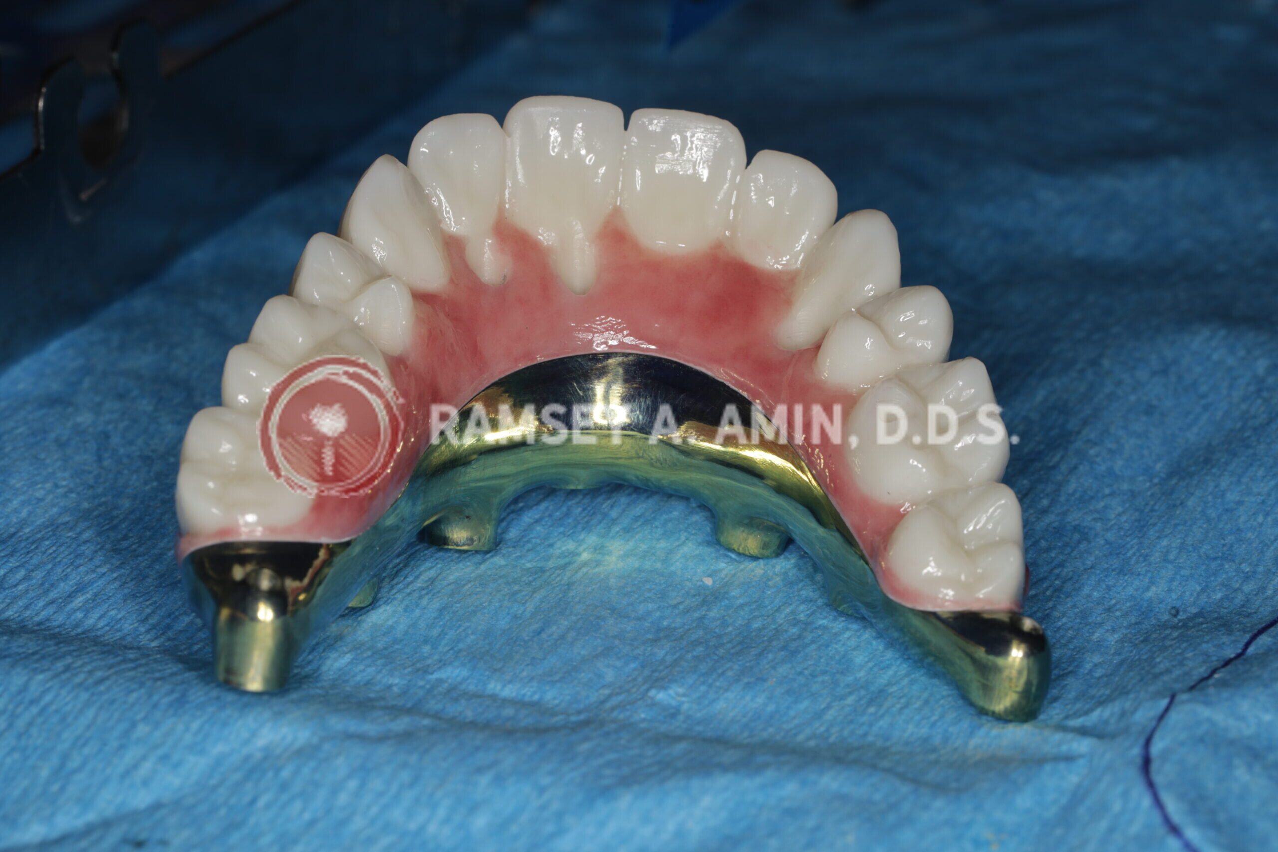 Milled titanium bar design for Fp3 all on 4 bridge --QUAD ZYGOMATIC
