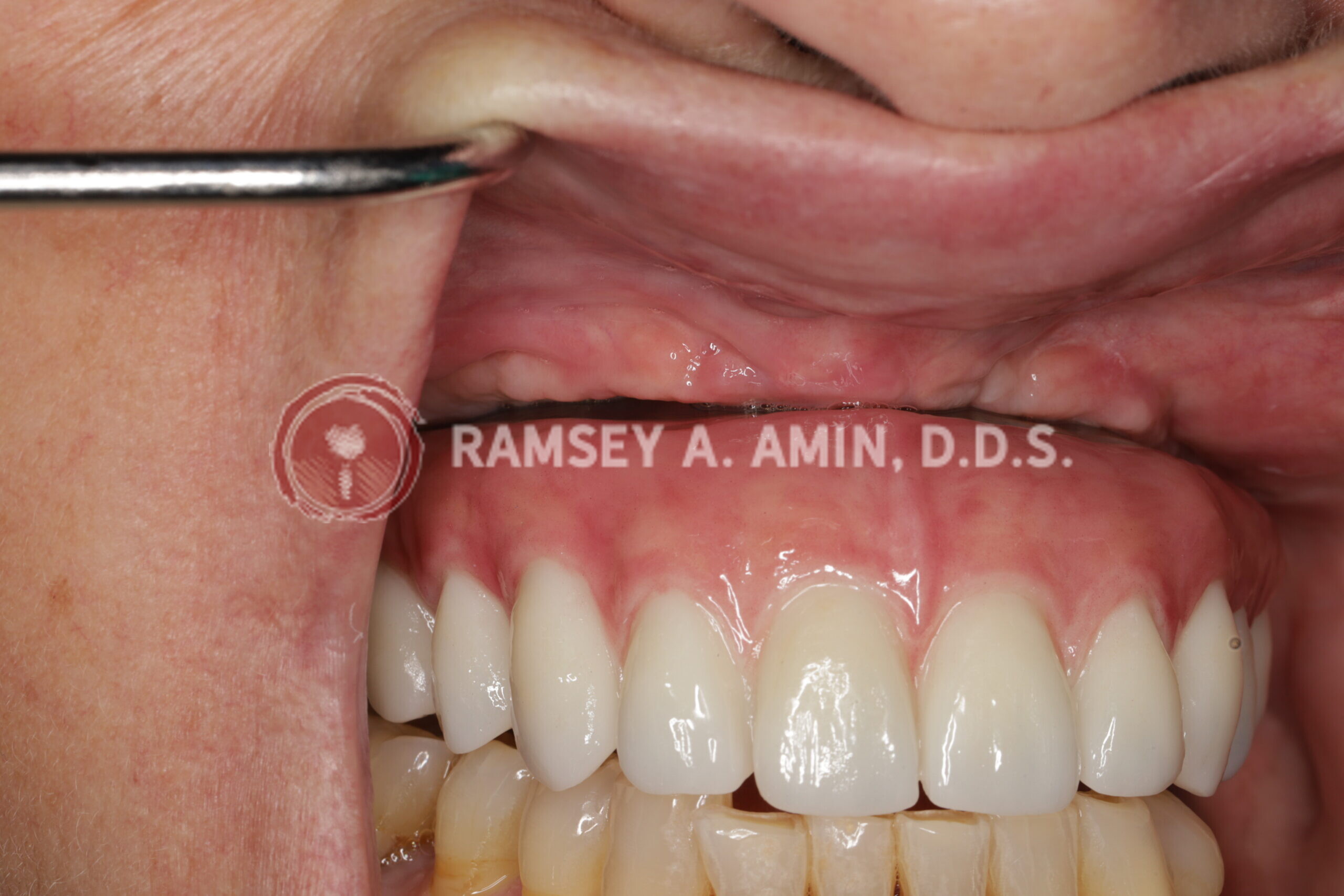 milled titanium bar design for Fp3 all on 4 bridge --bar barely visible in the mouth