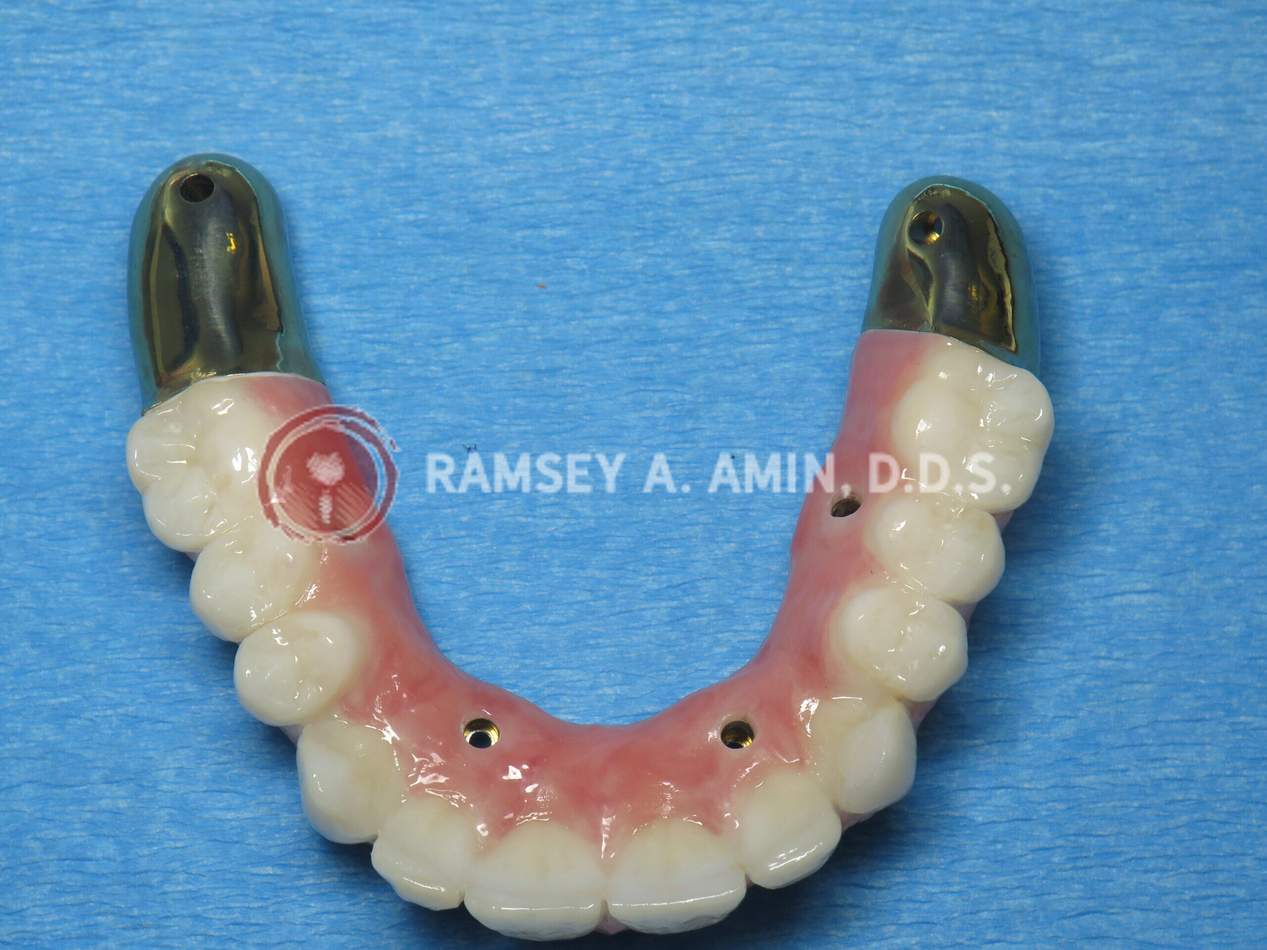 milled titanium bar design for Fp3 all on 4 bridge --pterygoids