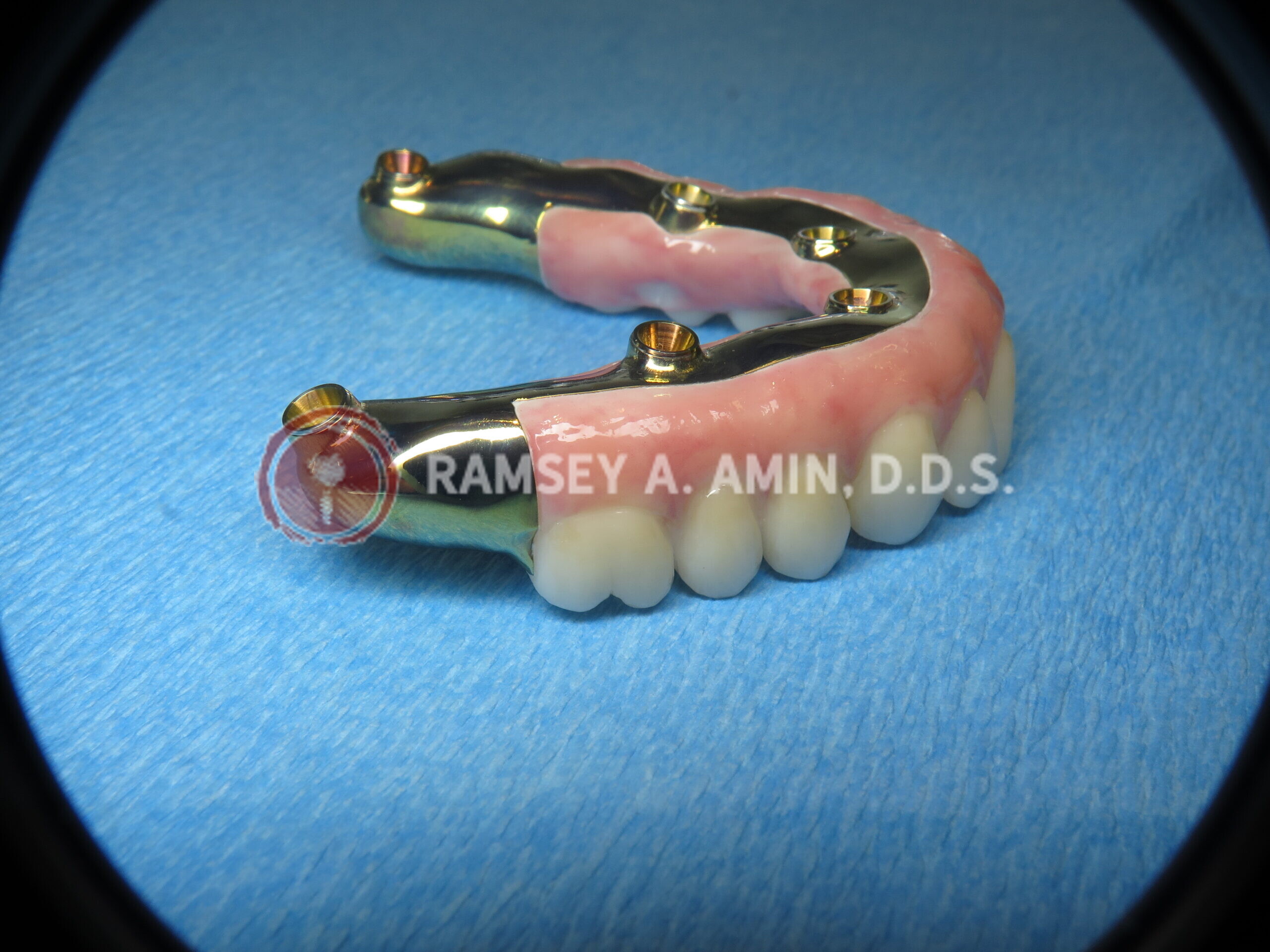 milled titanium bar design for Fp3 all on 4 bridge --pterygoids