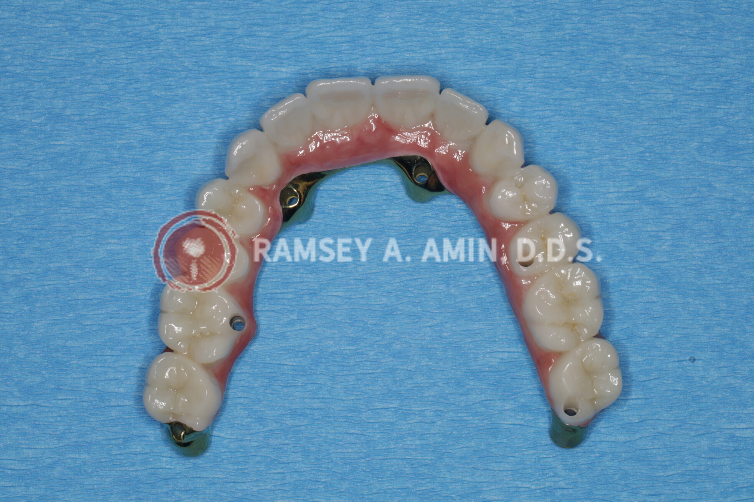 milled titanium bar design for Fp3 all on 4 bridge --pterygoids