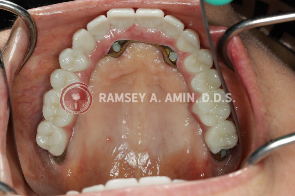 milled titanium bar design for Fp3 all on 4 bridge --pterygoids - actual patient of Dr. Ramsey Amin in Burbank, CA