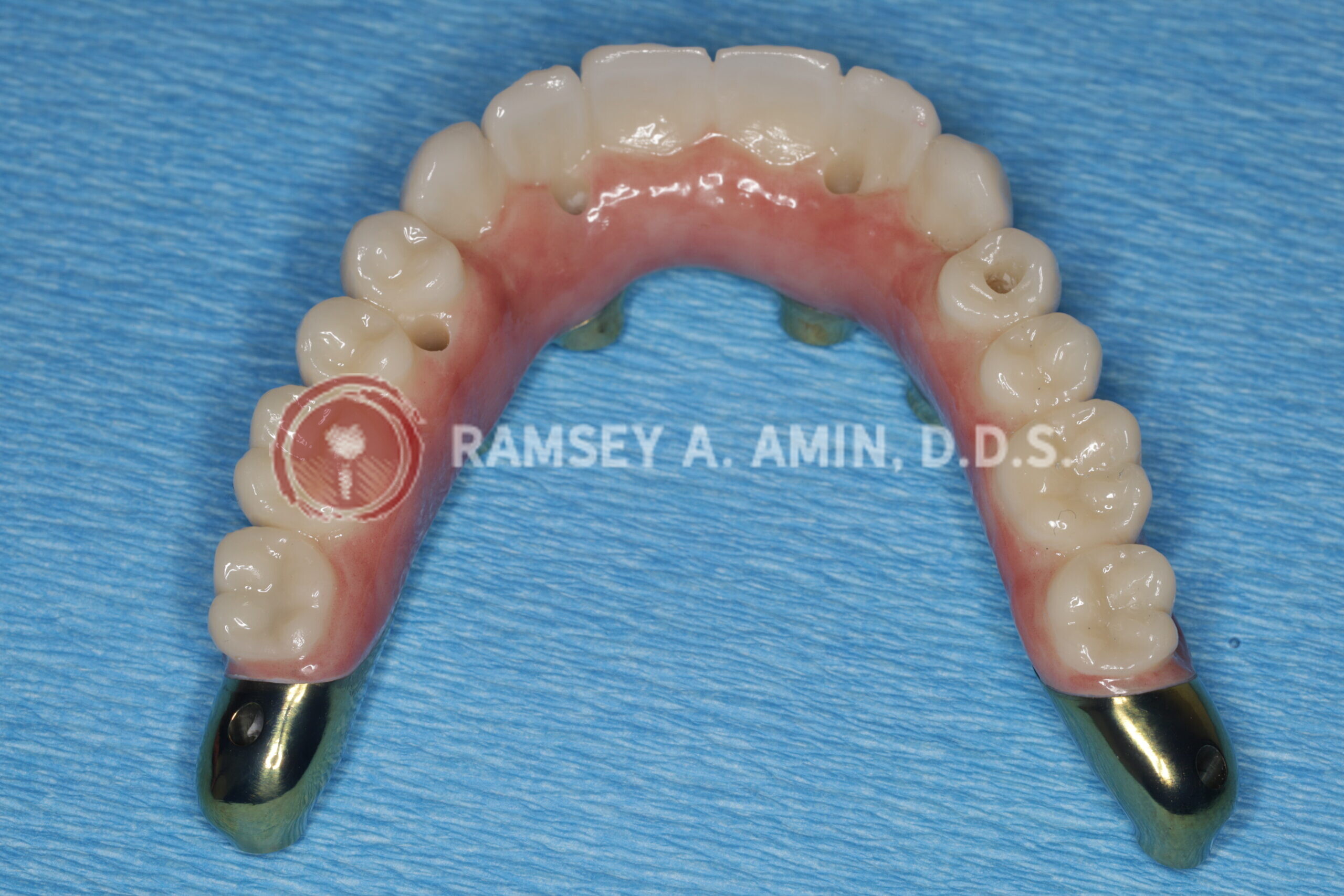 milled titanium bar design for Fp3 all on 4 bridge --pterygoids