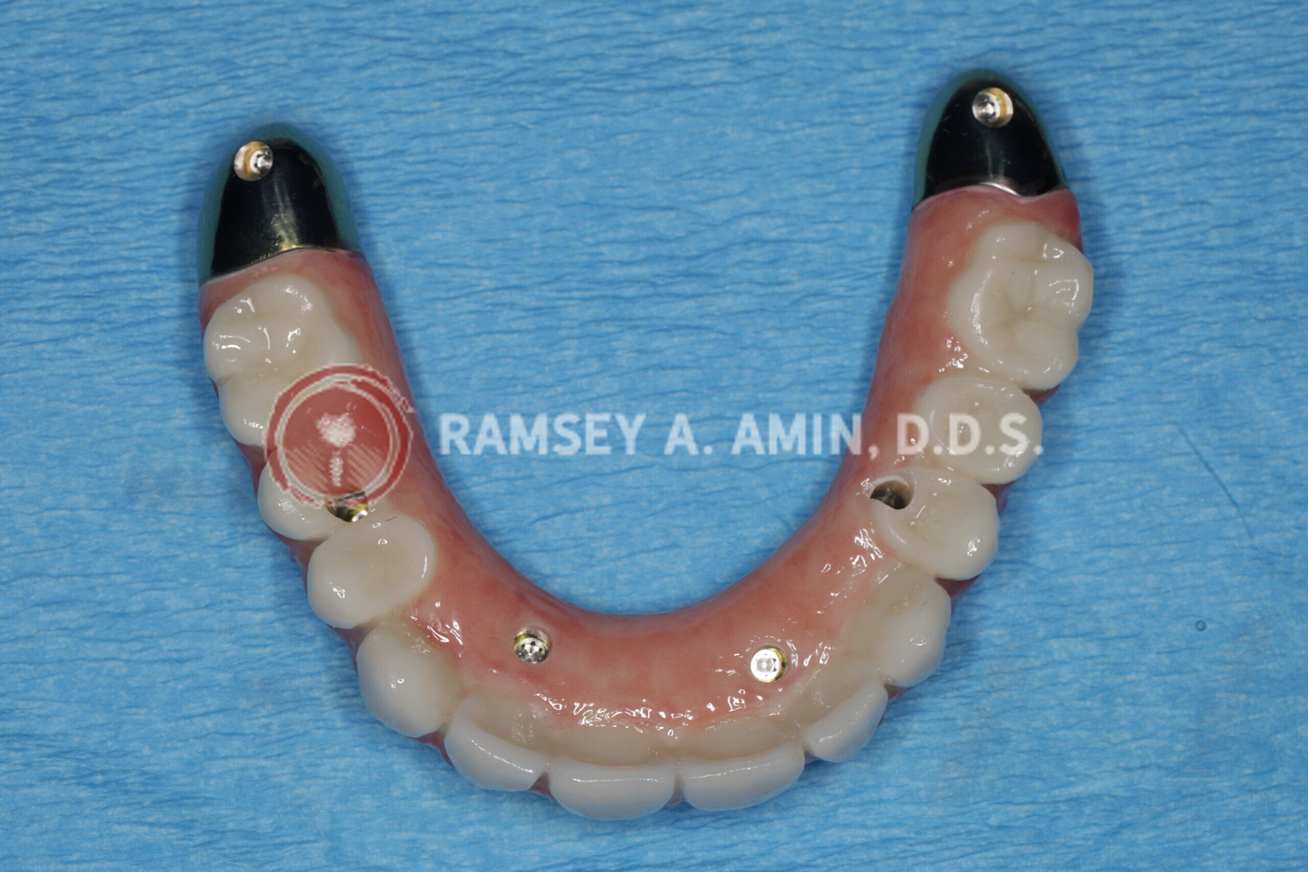 milled titanium bar design for Fp3 all on 4 bridge --pterygoids