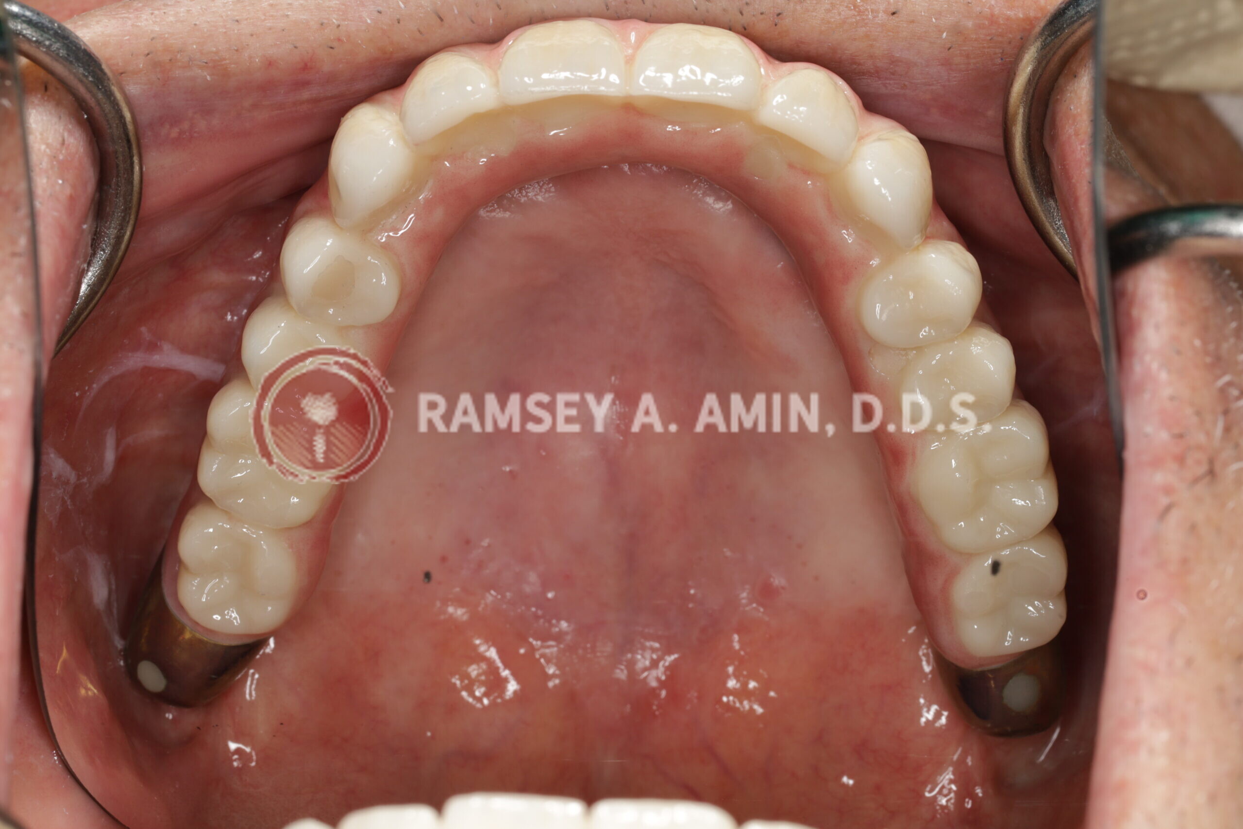 milled titanium bar design for Fp3 all on 4 bridge --pterygoids
