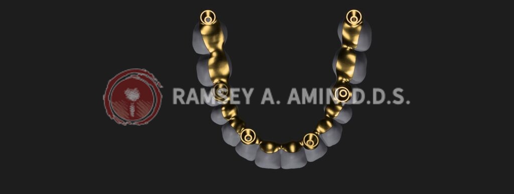milled titanium bar design for all on 4 bridge - by Ramsey Amin, DDS of Burbank Dental Implants